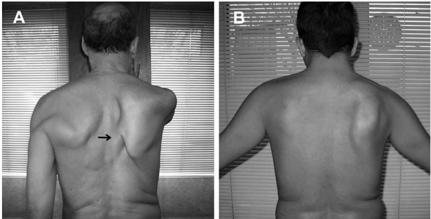 A: right LTN showing a medial pattern of winging with forward flexion while pushing against a wall. Arrow shows ropelike lower trapezius running obliquely towards the lower thoracic vertebrae, meaning the SAN is competent; B: right SAN palsy showing a lateral pattern of winging during abduction.