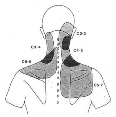 Pain maps with noxious stimulation of cervical facet joints in volunteers.[2]