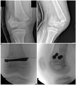 Figure 5: Salter-Harris II fracture of the distal femoral physis showing a large metaphysis fragment (Thurston-Holland fragment). Treated with open reduction and cannulated screw placement.