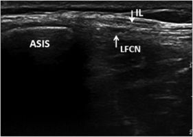 Transverse ultrasound image shows the nerve passing through the inguinal ligament. ASIS: anterior superior iliac spine; LFCN: lateral femoral cutaneous nerve; IL: inguinal ligament.[2]