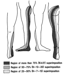 S1 block pattern: Extending from the midline of teh trunk posteriorly, across the buttock, through the lateral side of the thigh, the lateral side of hte leg, and teh medial side of the dorsum of the foot to the first digit.
