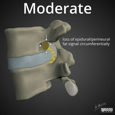 Moderate: circumferential lost of perineural fat signal