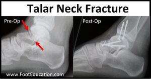 Talar neck fracture pre and post op xrays.jpg