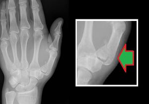 Figure 5: Bennett's fracture.