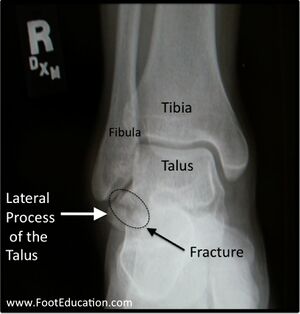 Talar lateral process fracture.jpg