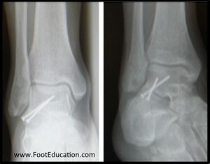 Lateral process fracture surgery.jpg