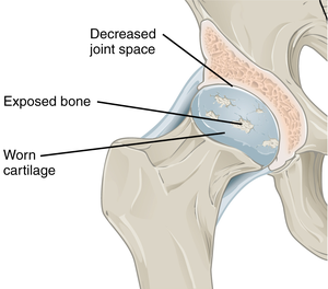 Hip osteoarthritis illustration.png
