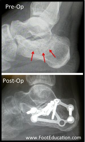 Depressed calcaneal fracture pre and post op.jpg