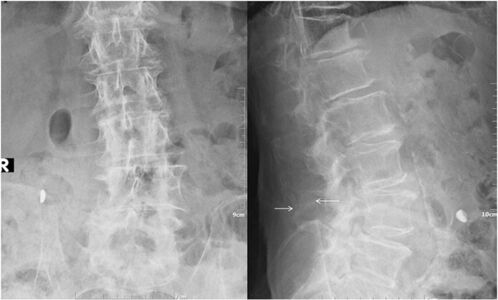 Lumbar spine X-ray, AP (left image) and lateral (right image) views illustrating close approximation and contact of spinous processes at L4-L5 level with sclerosis and flattening of the articulating surfaces (white arrow).[5]