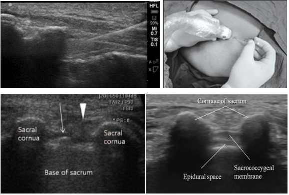 File:Caudal Epidural Injection Ultrasound.PNG