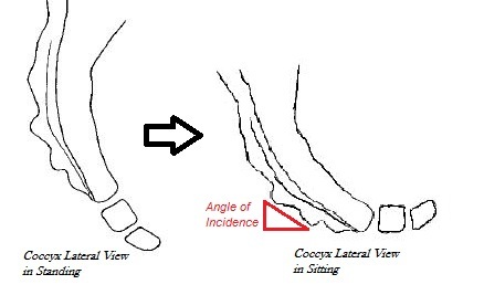 File:Coccyx angle of incidence.jpg
