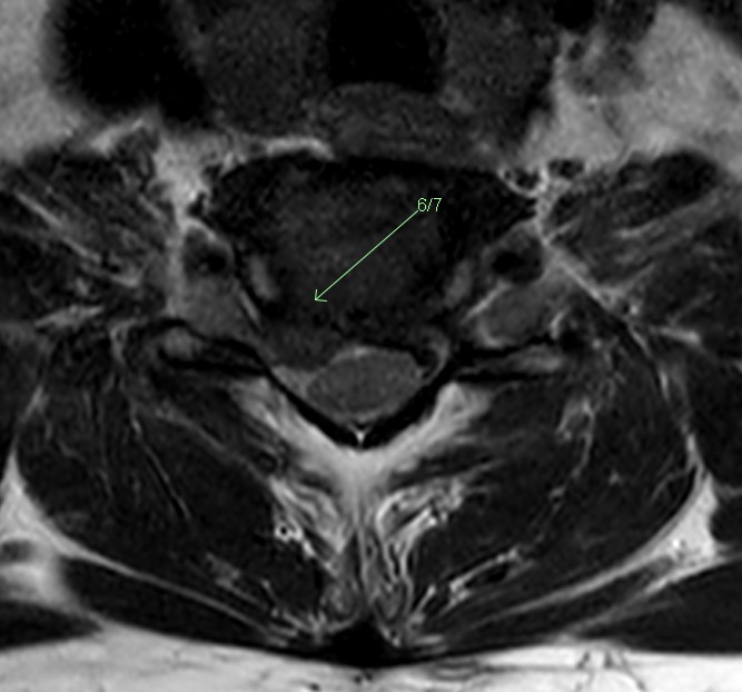 Right C6-7 disc protrusion MRI axial.jpg