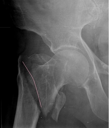 File:Intertrochanteric hip fracture.jpg
