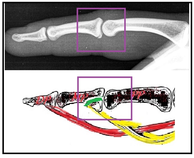 File:Superficial flexor tendon intra-articular fragment.jpg