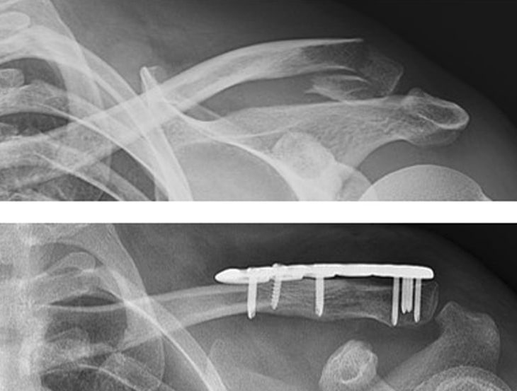 File:Clavicle fracture plate.jpg