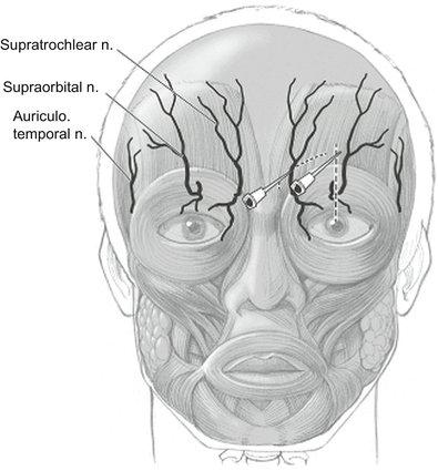 Supraorbital and supratrochlear nerve block.png