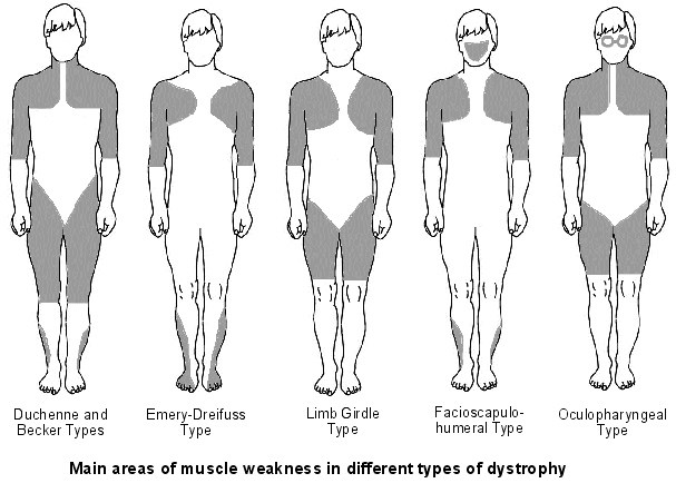 File:Muscular dystrophy weakness patterns.jpg