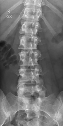 oblique view of lumbar spine