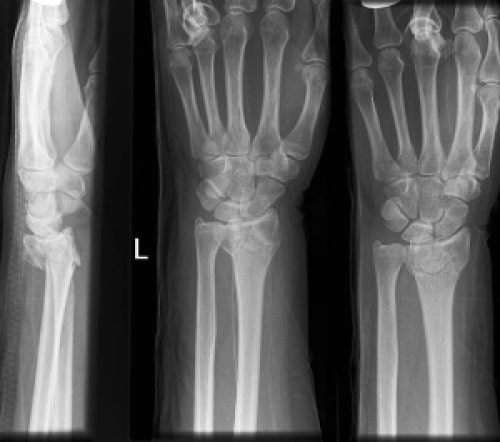 File:Colles fracture.jpg