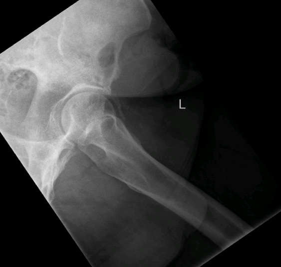 File:Leg pain case 001 L hip lateral.png