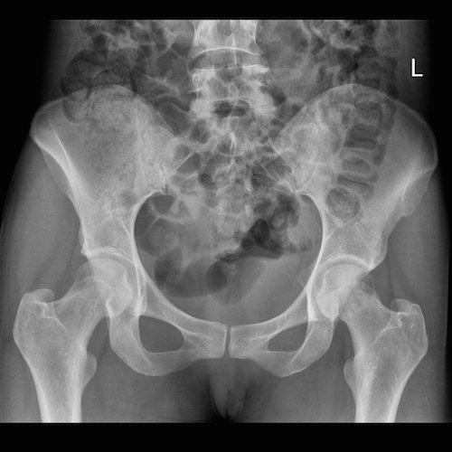 hip xray results normal study