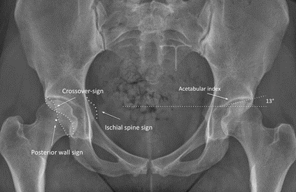 File:Crossover posterior wall and ischial spine signs xray.png