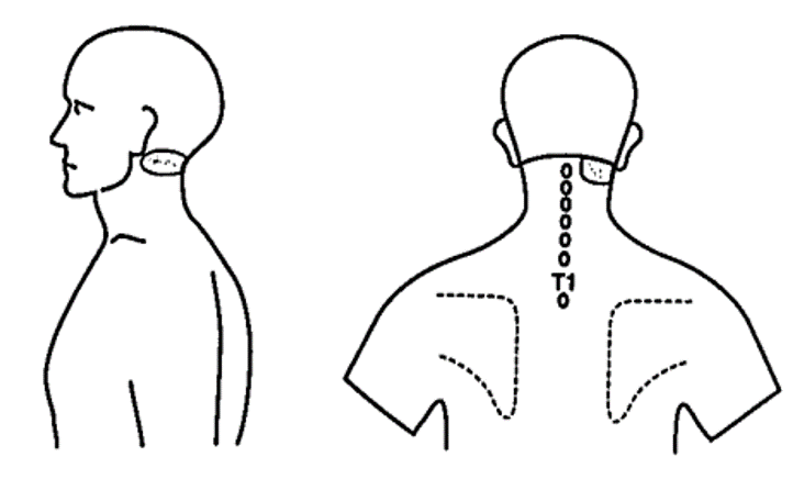 File:Atlanto-axial joint pattern dreyfuss.png