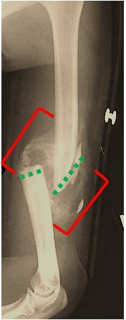 File:Humerus shaft fracture.jpg