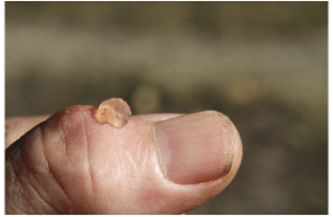 Mucous cyst of the thumb.png