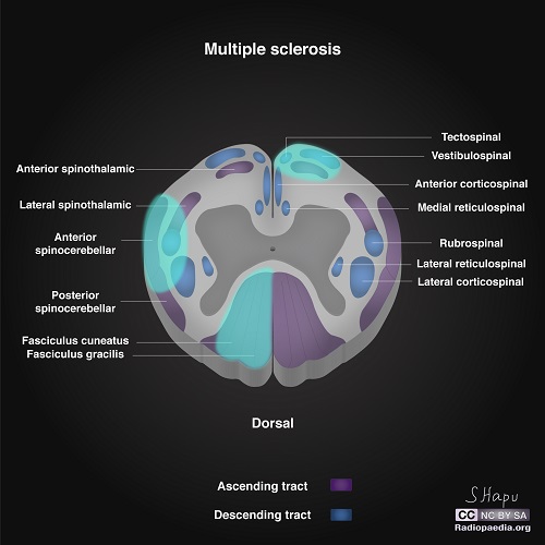 File:Incomplete-spinal-cord-syndromes-illustrations multiple sclerosis.jpg