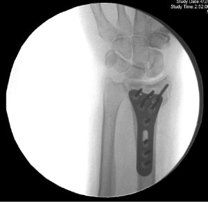 Colles fracture fixation.jpg