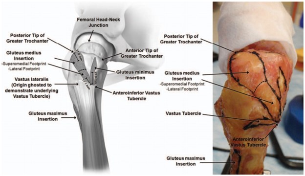 File:Lateral hip illustration and cadaver.jpg