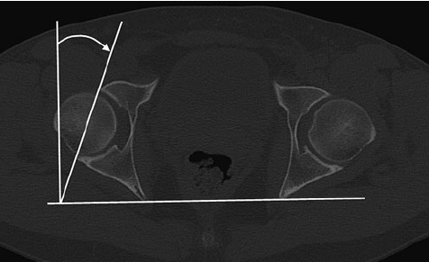 Figure 2 The acetabular version angle can be measured on CT in the axial plane. The acetabulum is normally anteverted to around 20°.