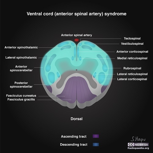 File:Incomplete-spinal-cord-syndromes-illustrations ventral.jpg