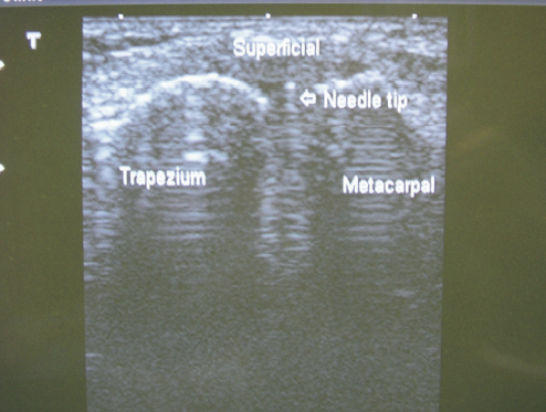 TMC joint ultrasound out of plane injection umphrey.png