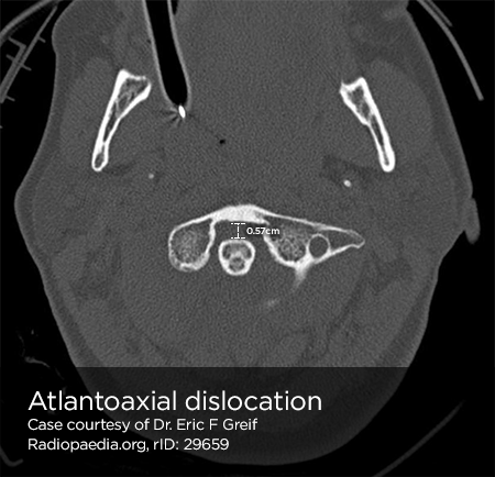 File:Atlantoaxial dislocation.png