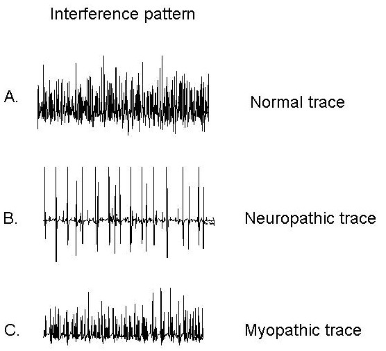 File:EMG neuropathic vs myopathic.jpeg