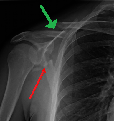 File:Scapula fracture xr.png