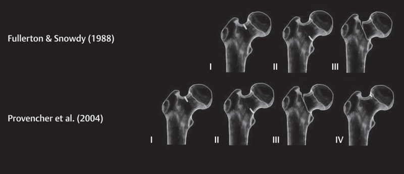 File:Femoral neck stress fracture classification.jpg