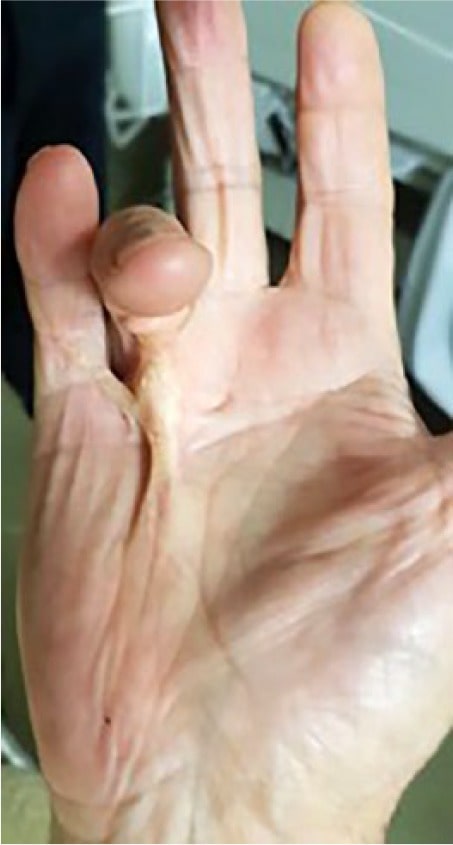 Dupuytrens contracture.jpg