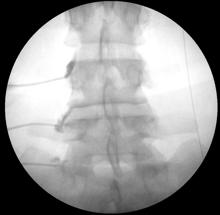 Lumbar medial branch blocks fluoroscopy left L3-5.jpg