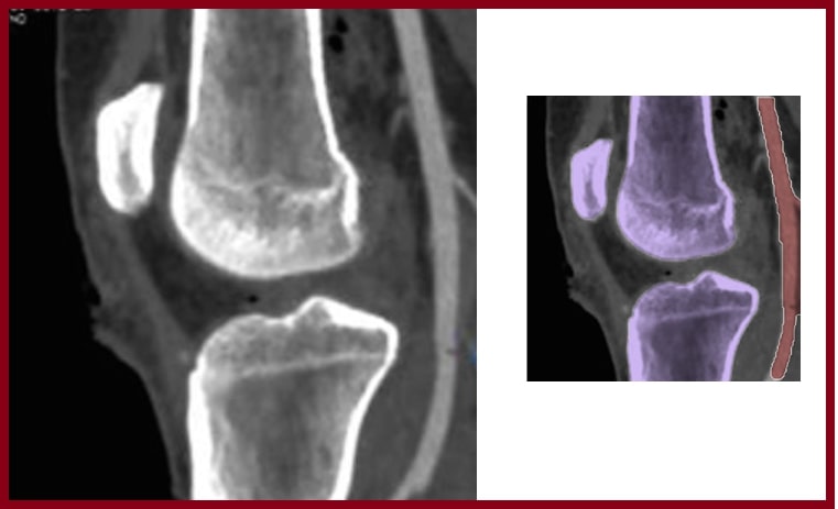 File:Popliteal artery knee xr.jpg