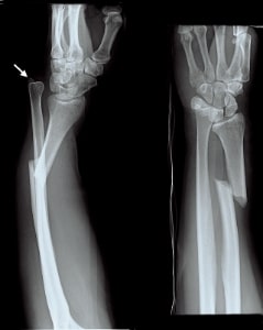 Figure 2: X-rays of a Galeazzi fracture.