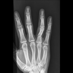 Proximal phalanx fourth finger extra-articular fracture.jpg