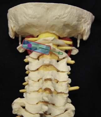 File:Cervical spine GON block.PNG