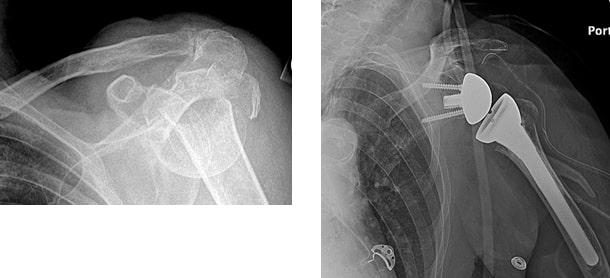 File:Humeral head fracture and reverse hemiarthroplasty.jpg