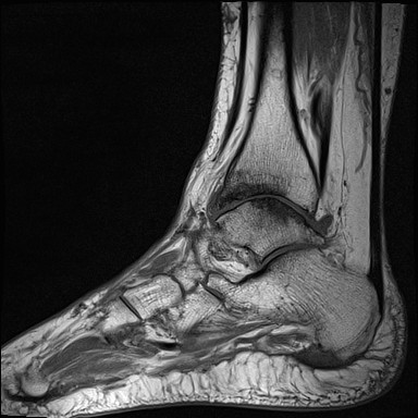 File:Ankle-osteoarthritis-mri.jpg