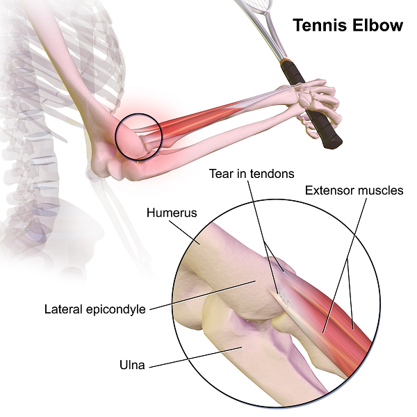 File:Lateral Elbow Tendinopathy.png