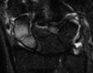 File:Occult scaphoid fracture MRI.jpg