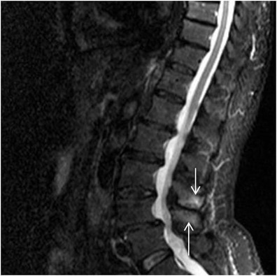File:Baastrup kissing spine bone oedema MRI.jpg